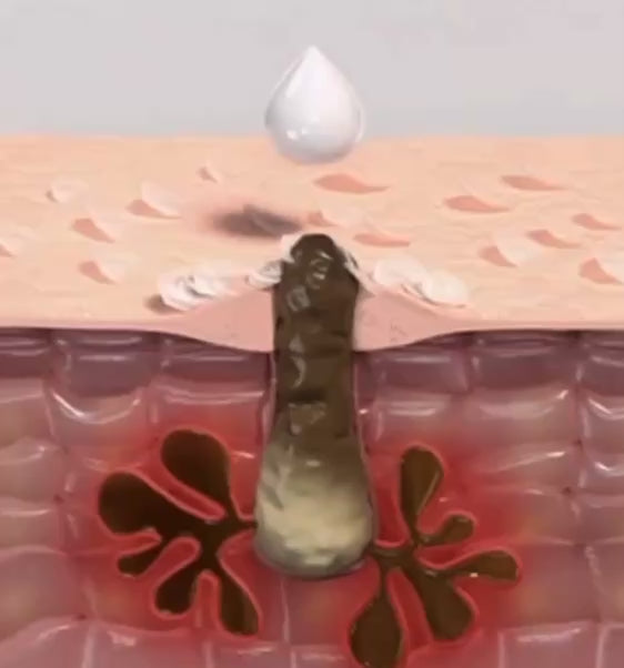 Charger la vidéo : <p>L'ampoule élimine en douceur les cellules mortes de la peau grâce aux ingrédients AHA (acides alpha-hydroxylés) et BHA (acides bêta-hydroxylés). Ces acides dissolvent les liens entre les cellules mortes à la surface de la peau pour révéler une peau plus fraîche en dessous.</p>